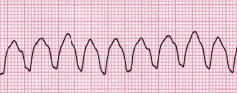 Ventricular tachycardia